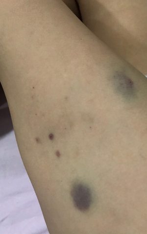 Thrombose Prophylaxe